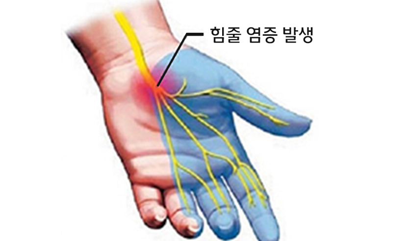 방아쇠손가락