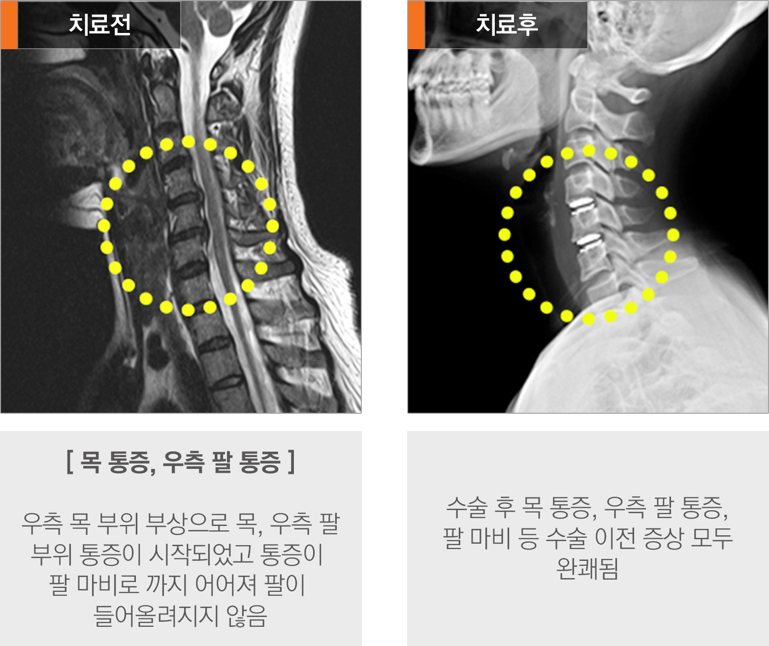 목디스크