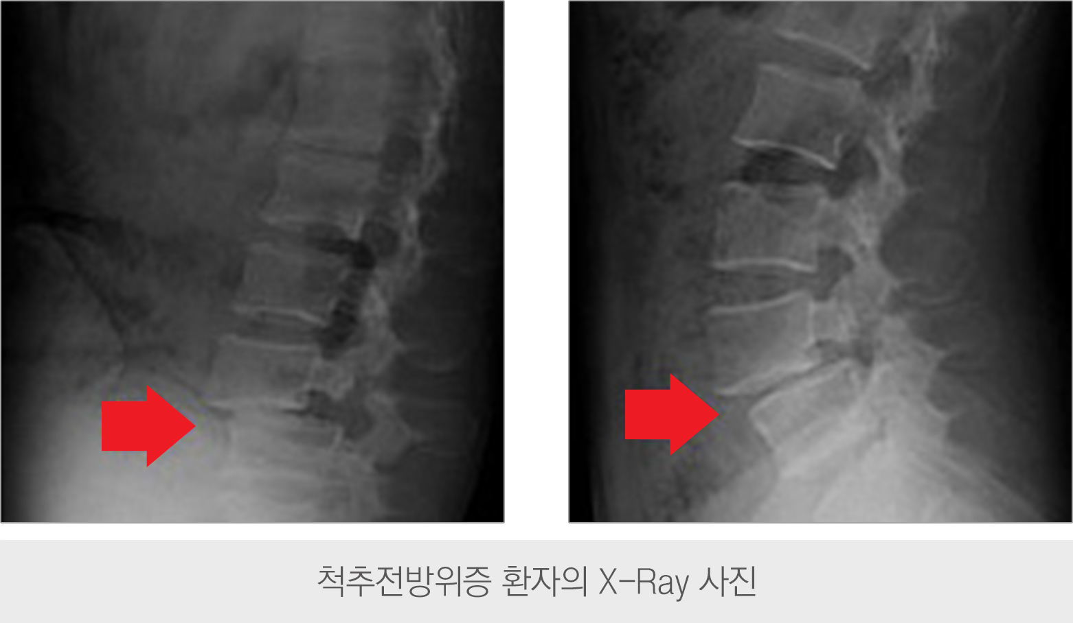 척추전방전위증