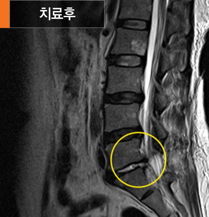 미세현미경디스크제거술