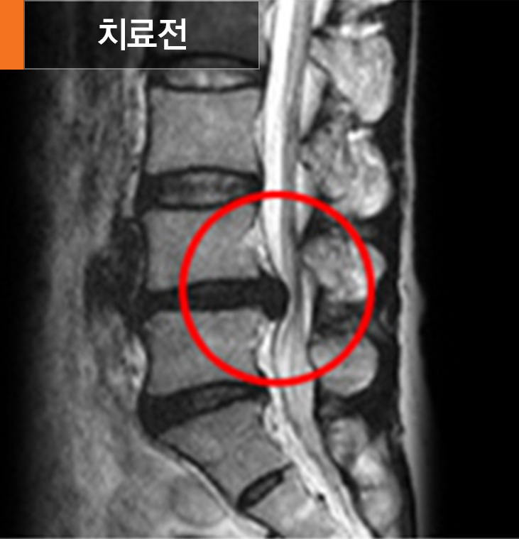 미세현미경일측성감압술