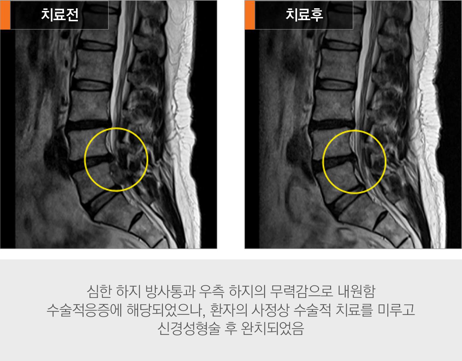 신경성형술