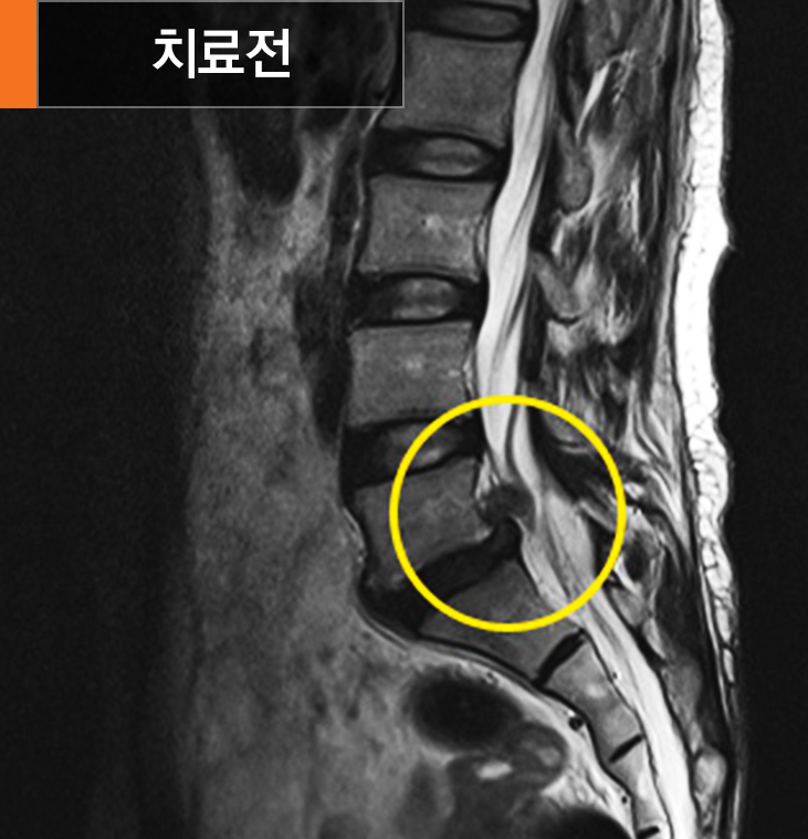 풍선확장술