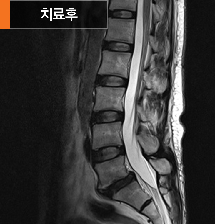 풍선확장술